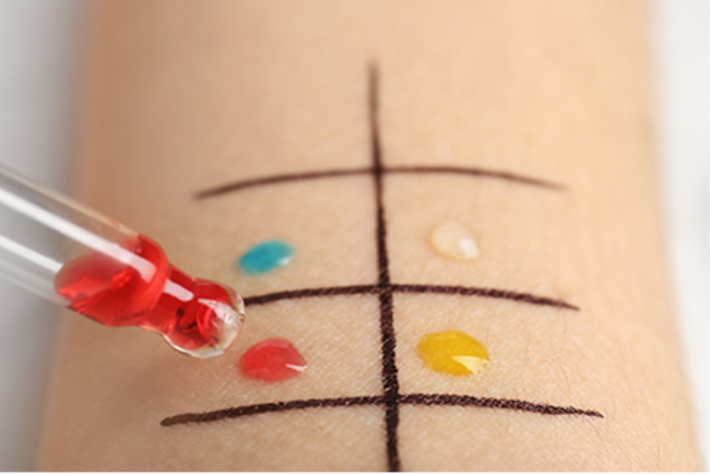 בדיקת תבחיני עור לזיהוי של אלרגיה